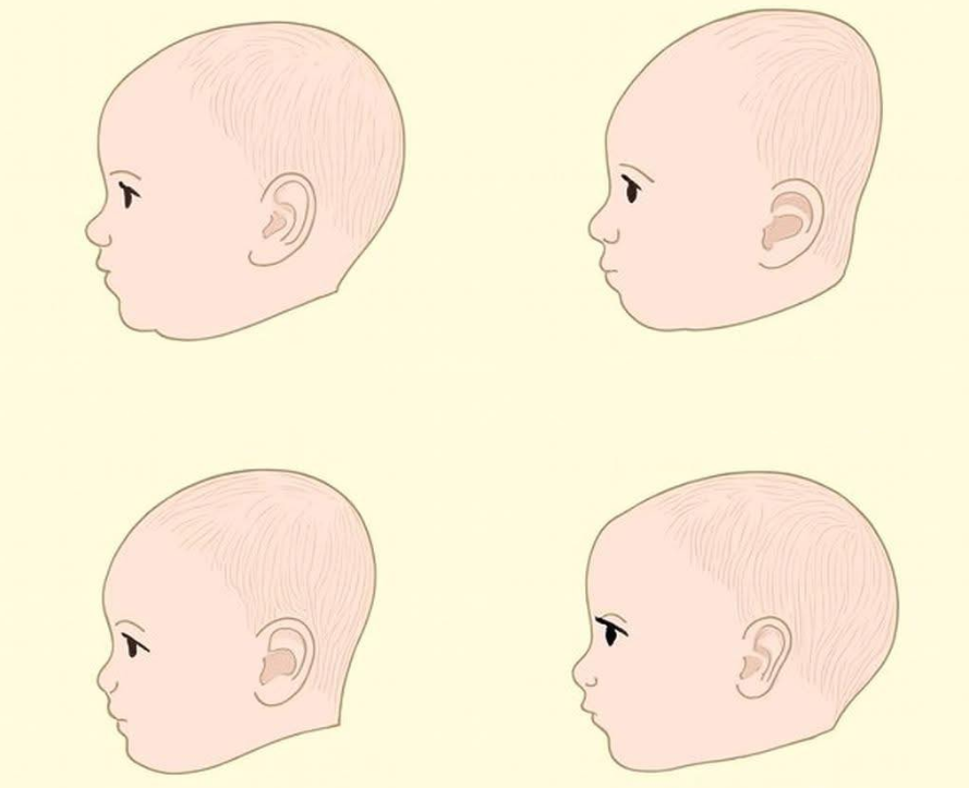 Forma capului bebelușului: când este cazul să ne îngrijorăm și cum poate ajuta osteopatia